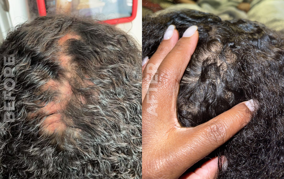 Understanding Dry Scalp: Causes, Identification, and Solutions with Our Stimulating Hair Growth Oil 🌿💆♀️