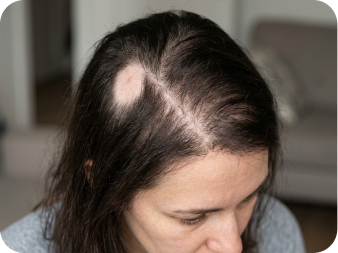 ALOPECIA & THINNING