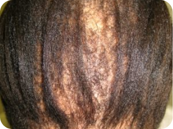 HAIRLINE, TEMPLES & CROWN