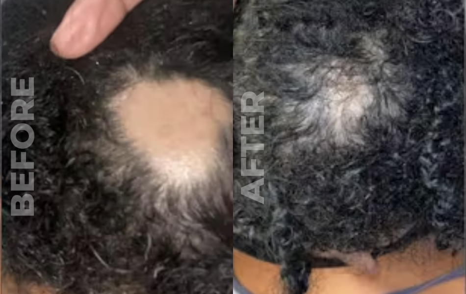 Alopecia Awareness: What is it?